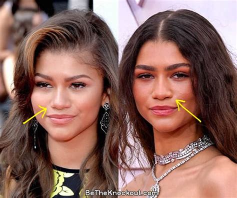 zendaya nose job